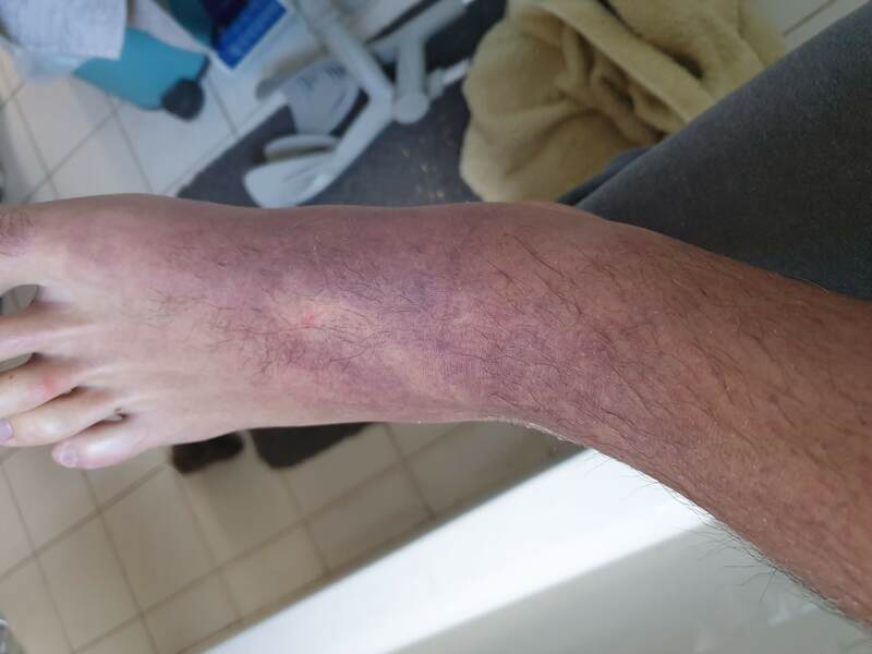 More bruising.